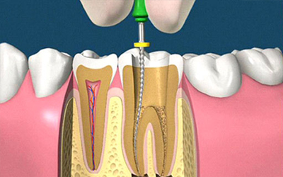 Endodonzia